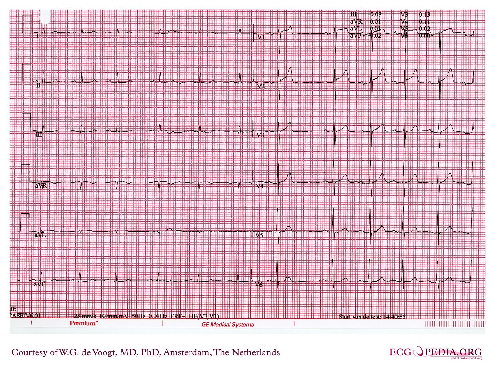 File:DVA0740.jpg - ECGpedia