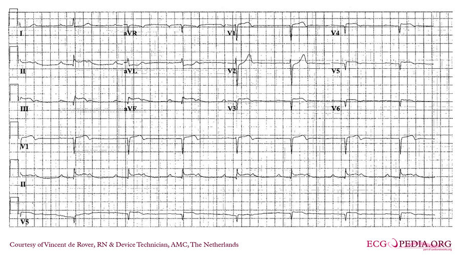 AMC Case 13 - ECGpedia