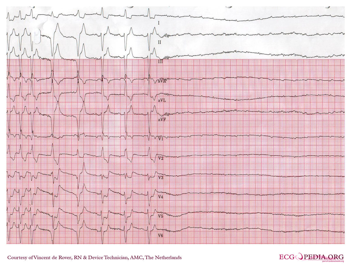 Amc Case 64 Ecgpedia