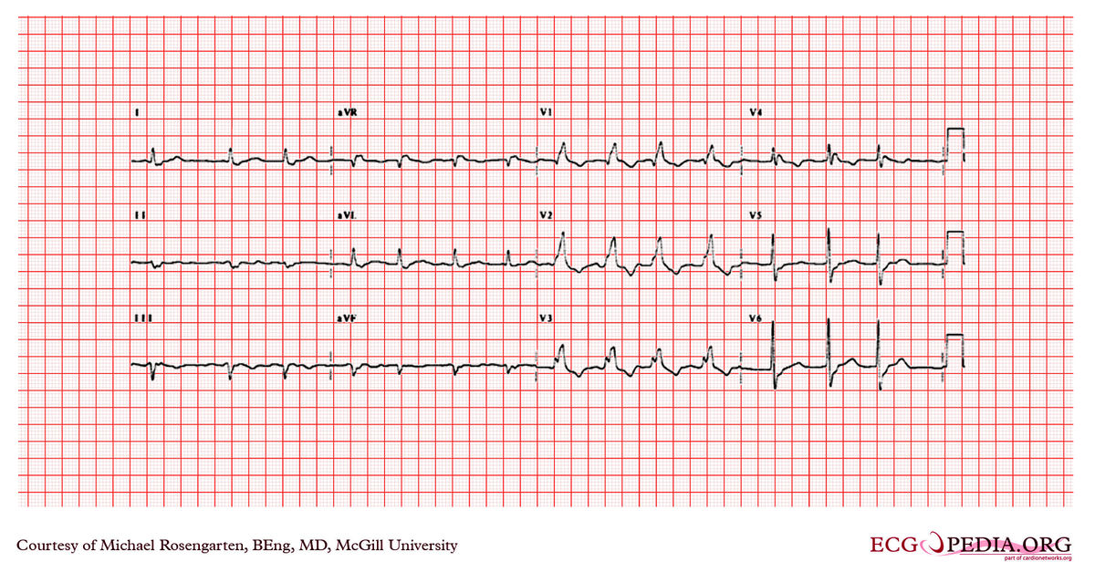 McGill Case 48 - ECGpedia