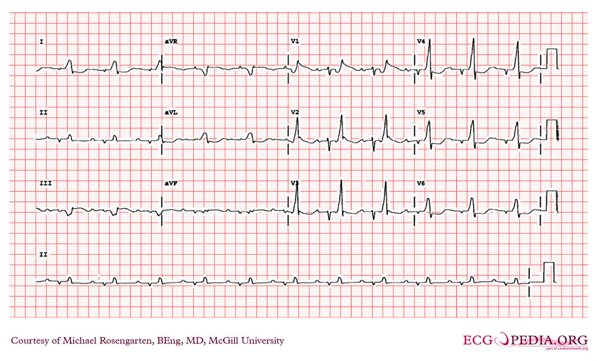 File:E000703.jpg - ECGpedia