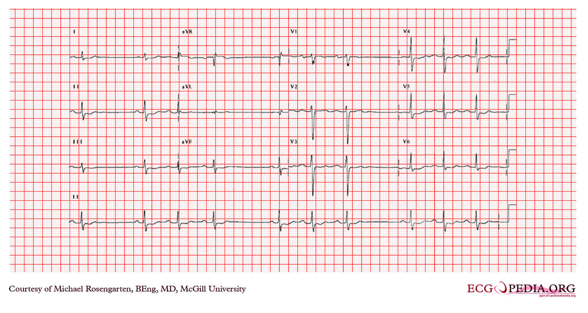 McGill Case 353 - ECGpedia