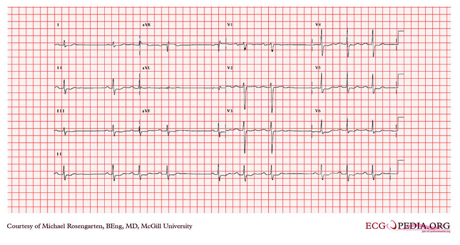 McGill Case 353 - ECGpedia