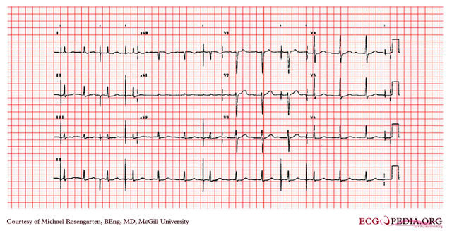 File:E269.jpg - ECGpedia