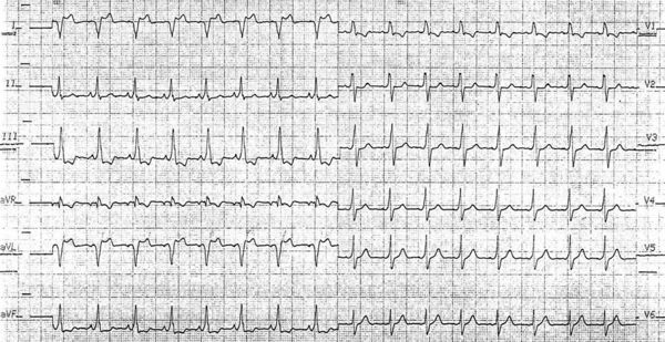 Puzzle 2006 3 108 Answer - ECGpedia