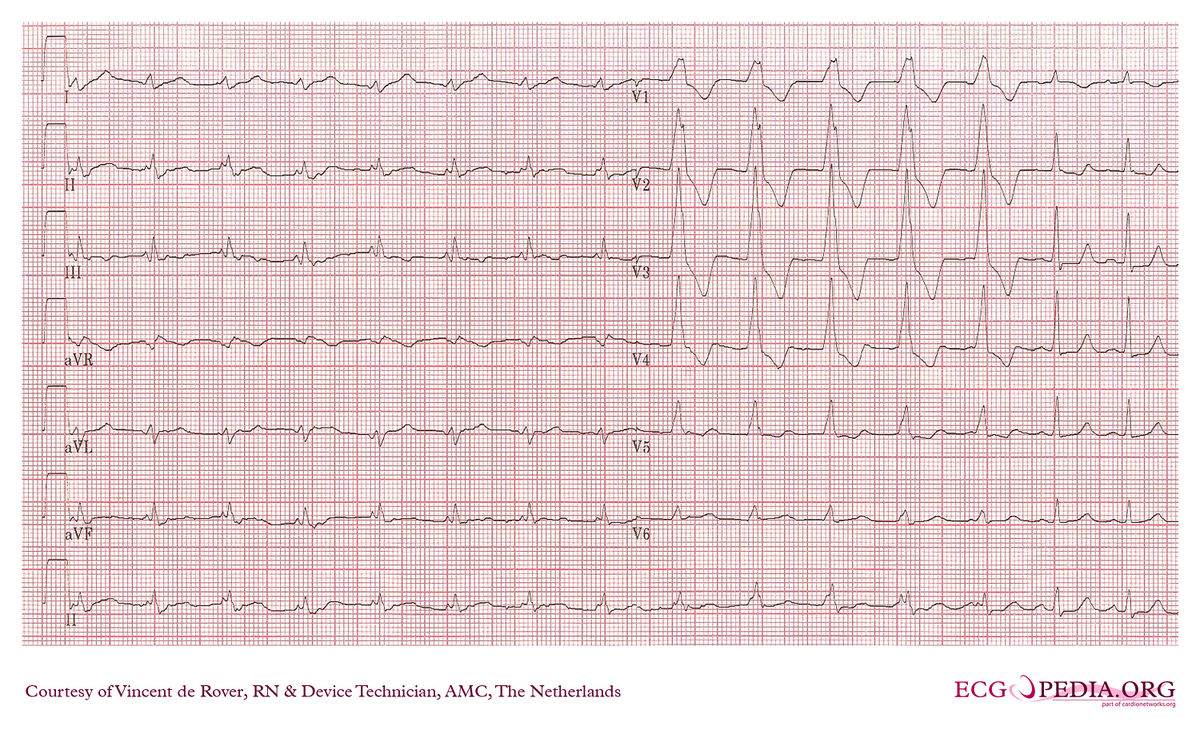 AMC Case 56 - ECGpedia