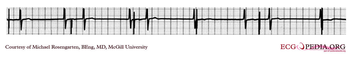 McGill Case 118 - ECGpedia