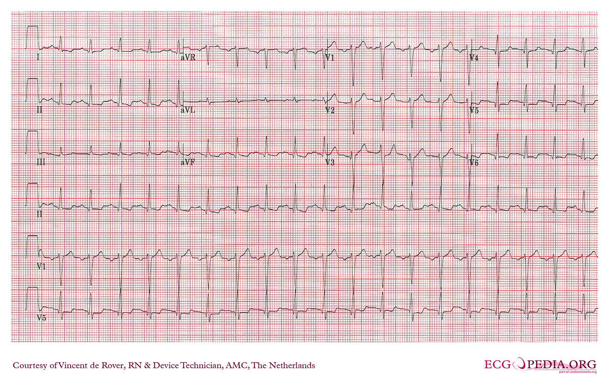 AMC Case 215 - ECGpedia