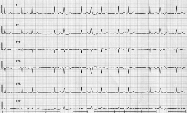 Answer 2008 05 - ECGpedia