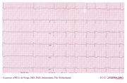 De Voogt ECG Archive - Arrhythmias - ECGpedia