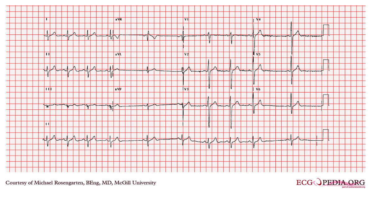 McGill Case 363 - ECGpedia