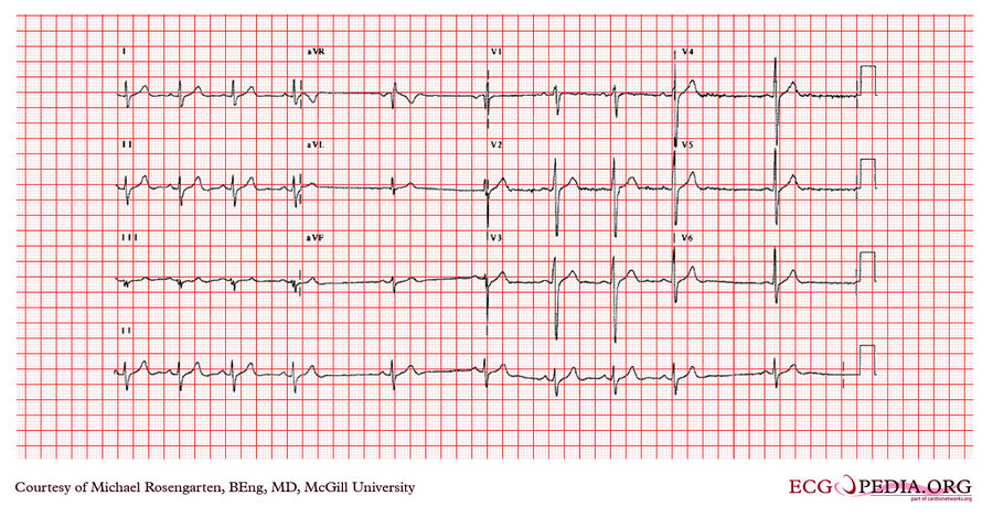 McGill Case 363 - ECGpedia