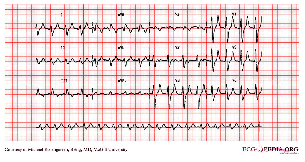 McGill Case 308 - ECGpedia