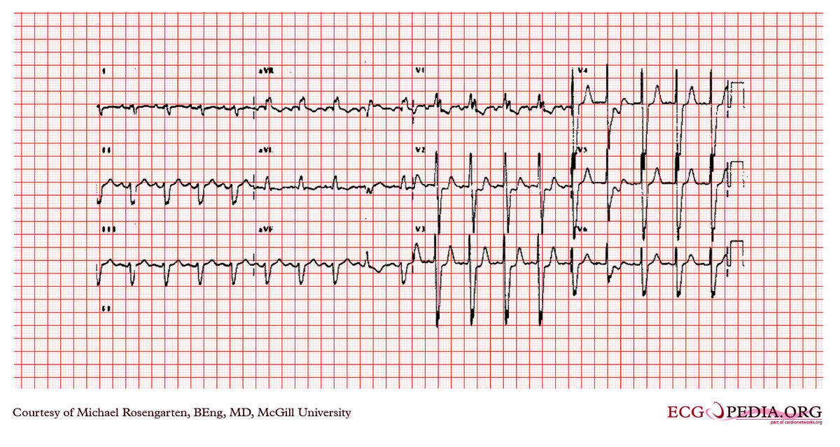 McGill Case 342 - ECGpedia