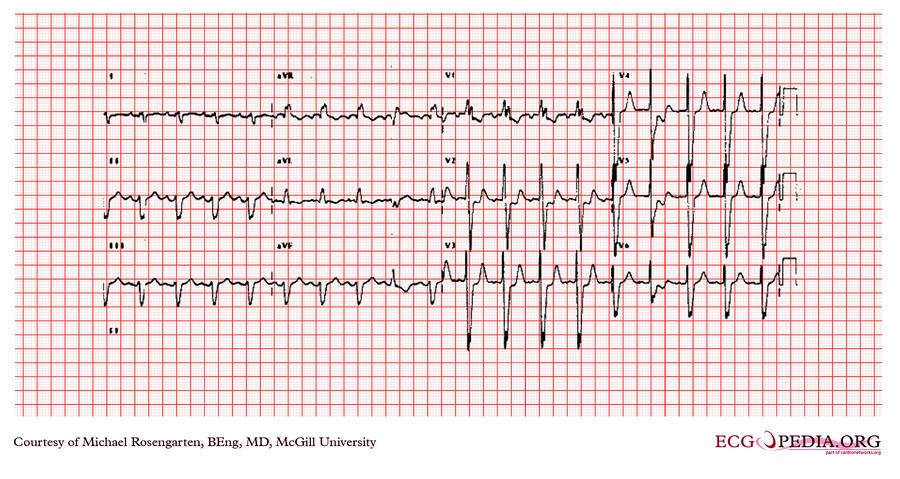 Mcgill Case 342 - Ecgpedia