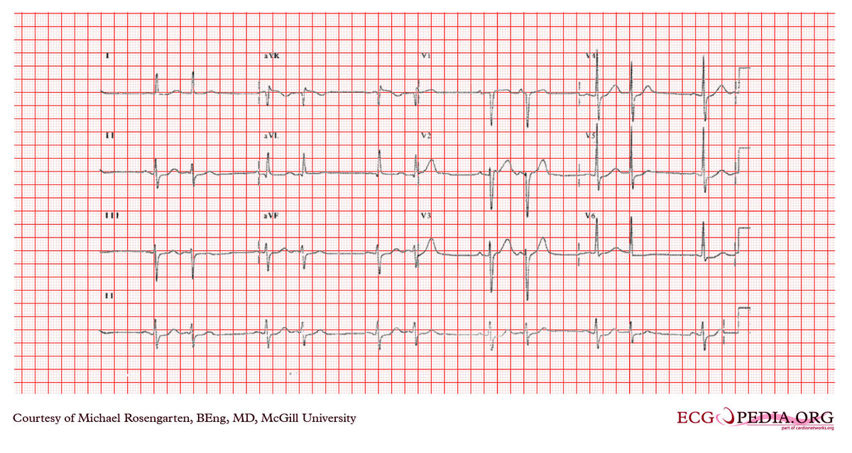 McGill Case 356 - ECGpedia