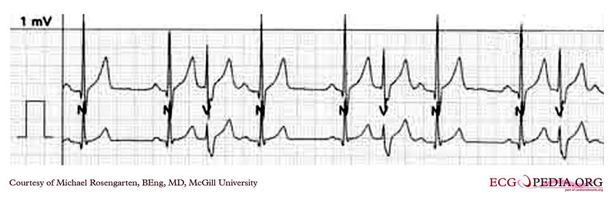 Mcgill Case 282 Ecgpedia