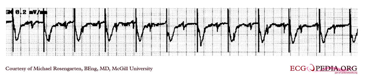 File:E0003108.jpg - ECGpedia