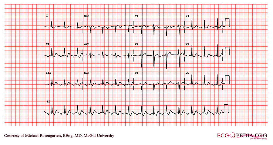 McGill Case 56 - ECGpedia