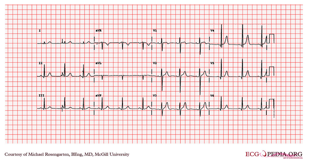 McGill Case 188 - ECGpedia