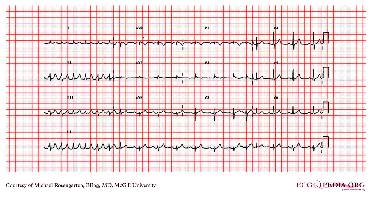 McGill Case 207 - ECGpedia