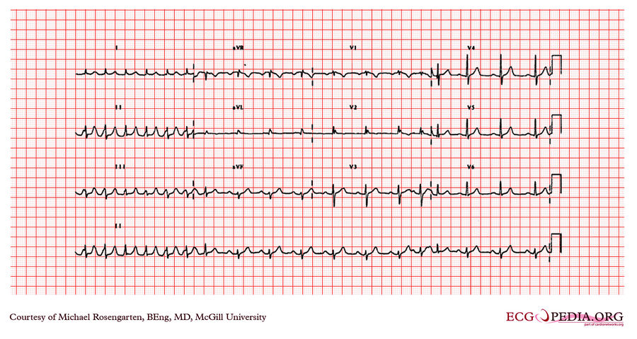 McGill Case 207 - ECGpedia