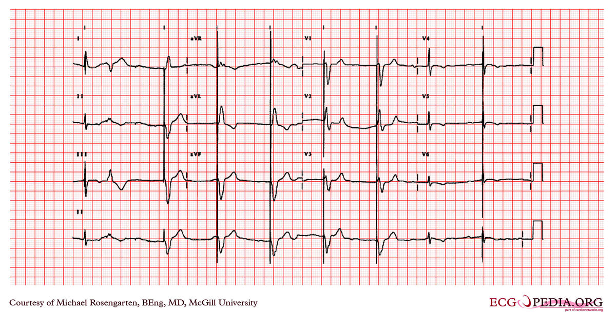 McGill Case 332 - ECGpedia