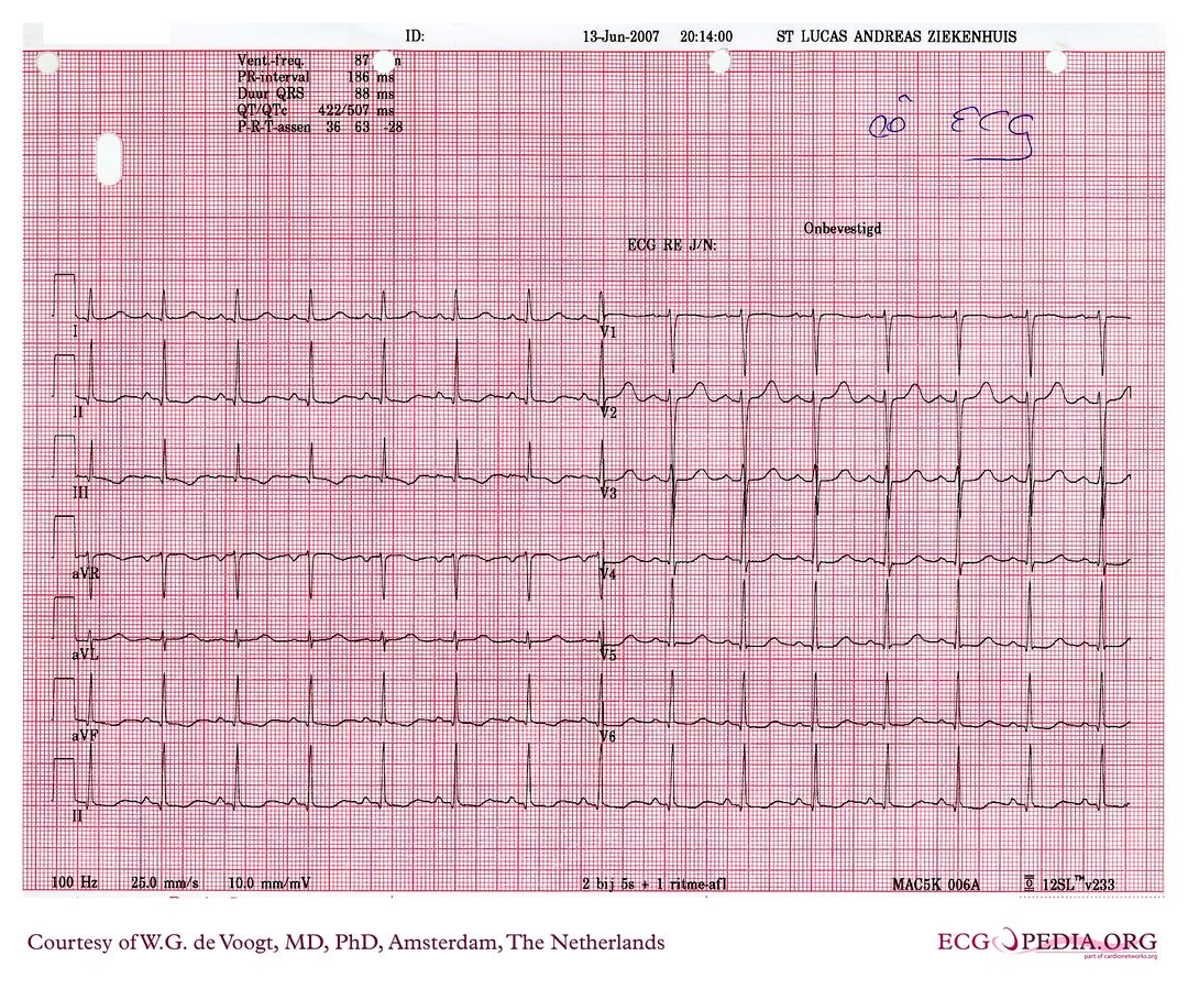 File:DVA0605.jpg - ECGpedia