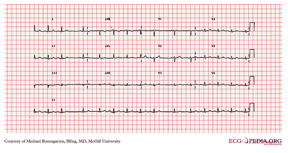 McGill Case 238 - ECGpedia