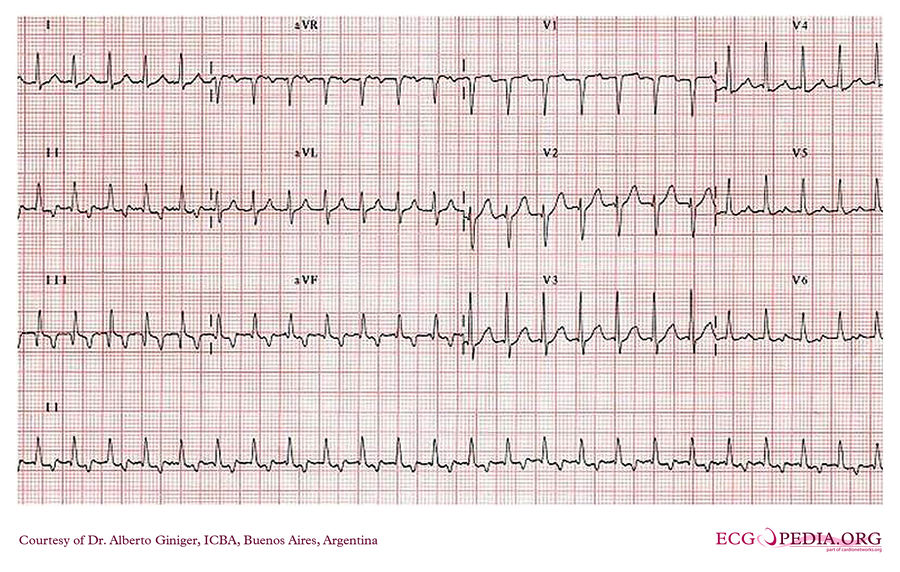 ICBA5 - ECGpedia