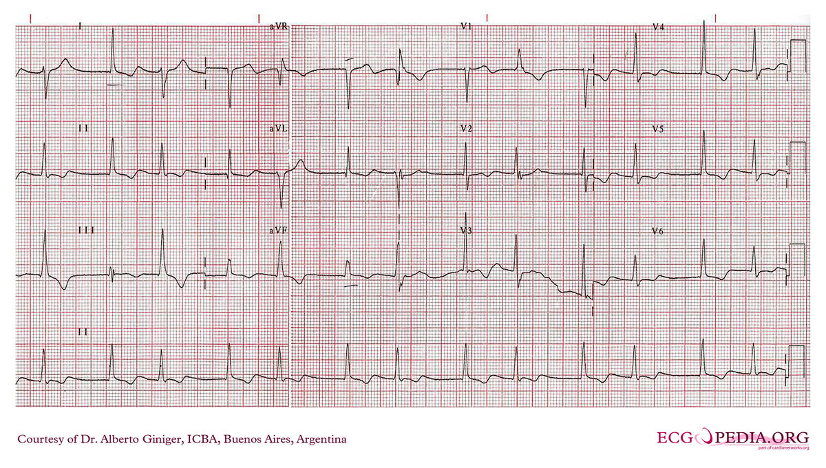 ICBA12 - ECGpedia