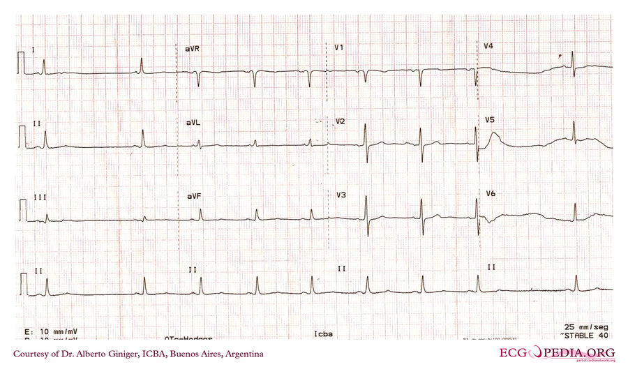 ICBA37 - ECGpedia