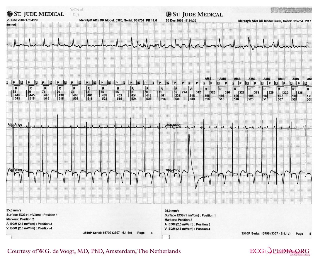 File:DVA1778.jpg - ECGpedia