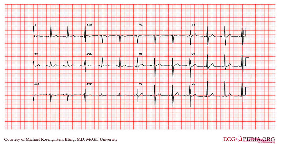 McGill Case 189 - ECGpedia