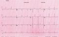 An ECG of a patient with hypocalcemia