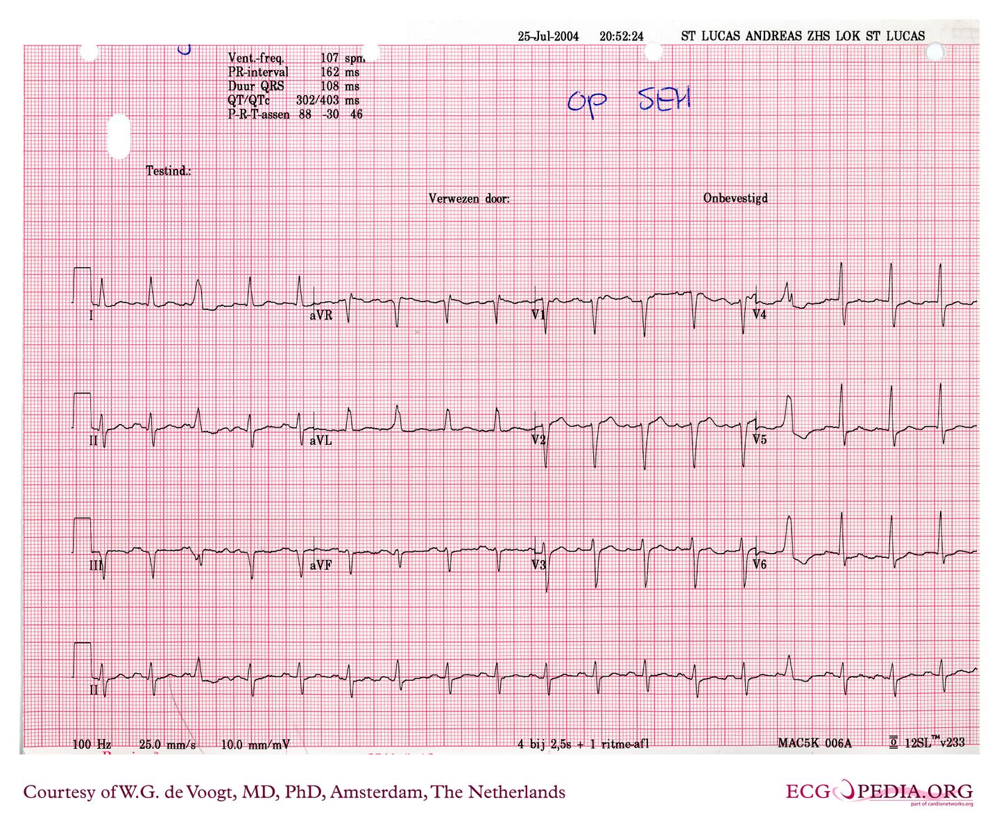 File:DVA0030.jpg - ECGpedia