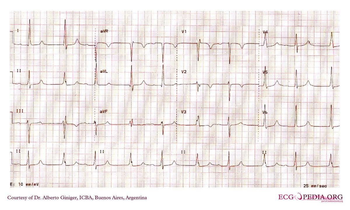 ICBA39 - ECGpedia