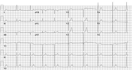 Puzzle 2005 8 285 - Answer - ECGpedia