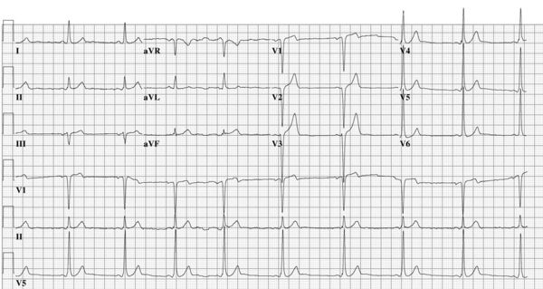 One is Enough, Two is Too Many - ECGpedia