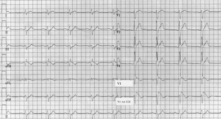 Puzzle 2006 1 33 - Answer - ECGpedia