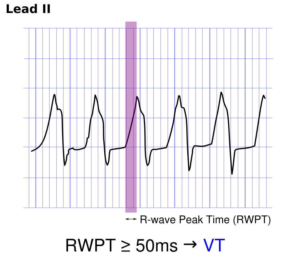 Peak time. ECG graph. ECGPEDIA. Time time Peak ventricular Pressure.