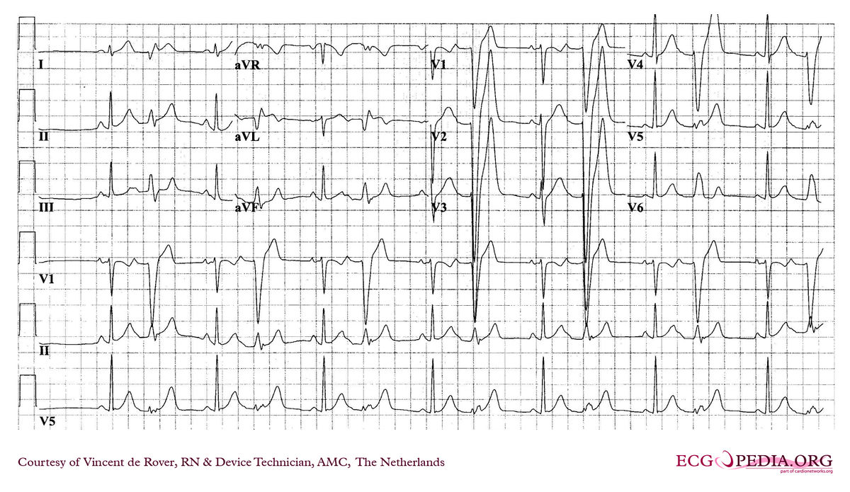 AMC Case 247 - ECGpedia