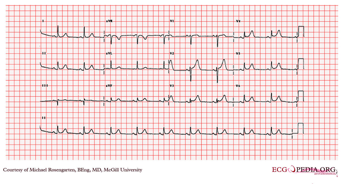 Mcgill Case 67 - Ecgpedia