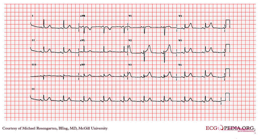 McGill Case 67 - ECGpedia