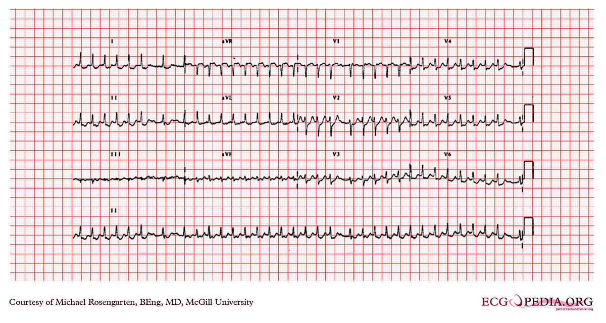 McGill Case 272 - ECGpedia