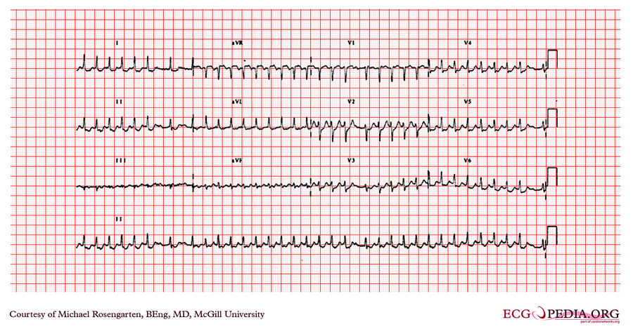 McGill Case 272 - ECGpedia