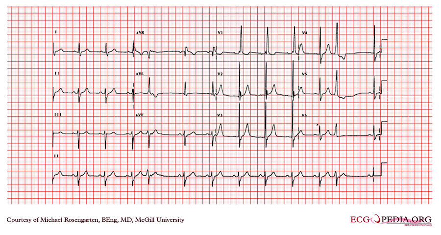 McGill Case 77 - ECGpedia