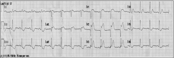 Puzzle 2008 04 014 Answer - ECGpedia