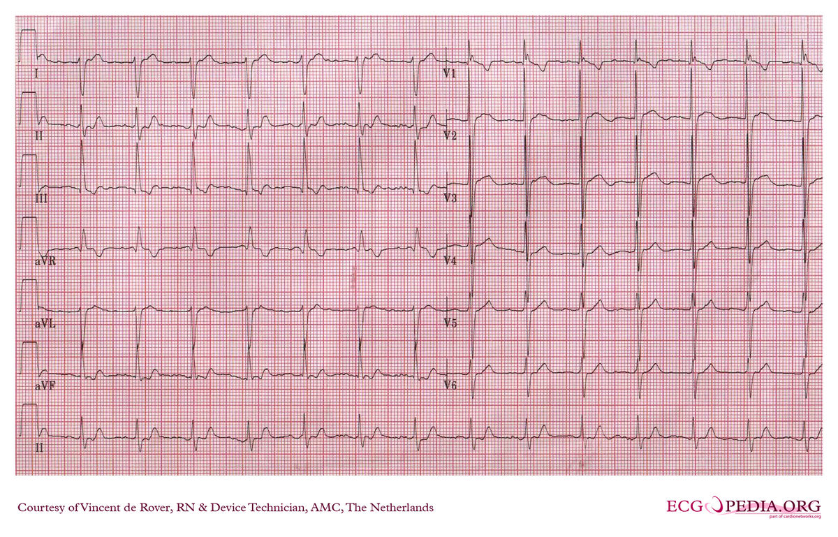 AMC Case 144 - ECGpedia