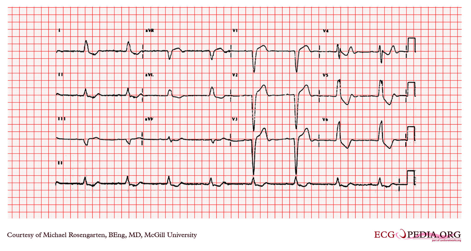 File:E000712.jpg - ECGpedia